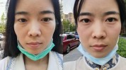 上了双眼皮性也到热玛吉(男性自己的项目双眼皮女性)