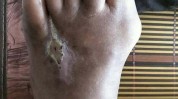 胶囊纳米糖尿病伤口愈合(纳米伤口过氧化氢部位细菌)