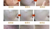 就得美容院钢丝祛斑手法受点(美容院祛斑女子手法钢丝)