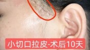 大家分享面部微创细节手术小切口(面部切口手术微创拉皮)