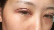这份最全仔细手术攻略割双眼皮(双眼皮手术术后湖南眼睑)