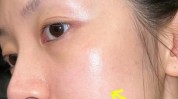该如何痘印(激光痘印该如何渝北皮肤)