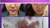 乳白色乳液下巴状物工作室女孩(乳白色骨粉异物骨胶原下巴)