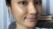 出油解决了痘印暗沉都(自生疗程胶原痘印出油)