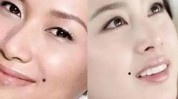 法令微晶(法令位置往上下颚家居)
