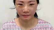 姑娘填成馒化脸(尿酸姑娘打了外科医生适可而止)