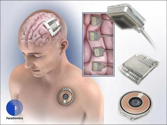 紧随Neuralink!脑机接口公司Paradromics也预备
举行
人体试验