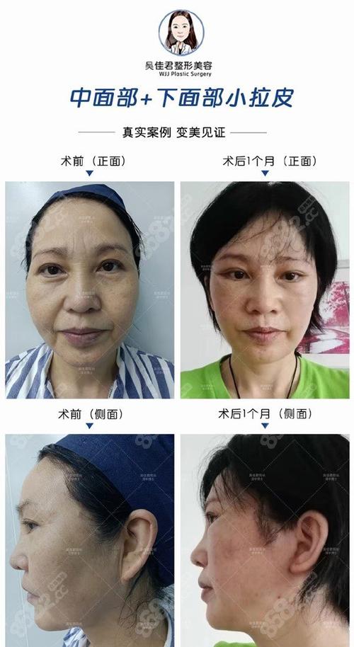 看懂整形美容常见项目(手术时间隆鼻拉皮看懂)