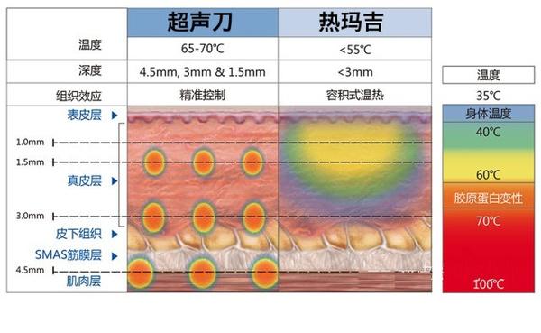光子超声波详解项目热玛吉(光子超声波项目详解皮肤)