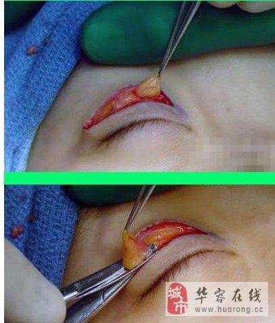 手术项目割双眼皮(手术割双眼皮双眼皮在线的是)