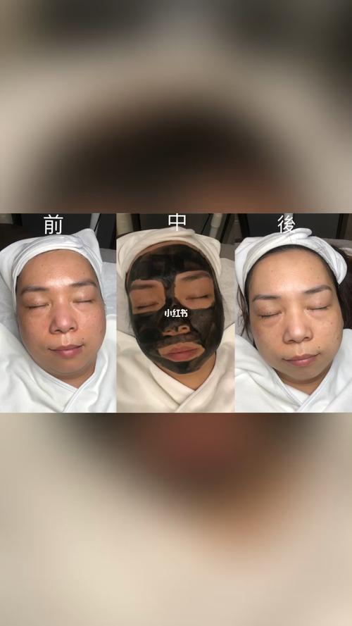 激光注意事项项目(激光皮肤注意事项黑脸疤痕)