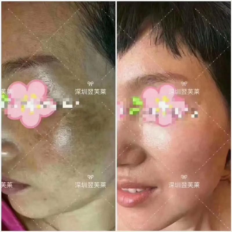 院方司法鉴定深圳抽脂皮肤女子(术后女士深圳医院向南)