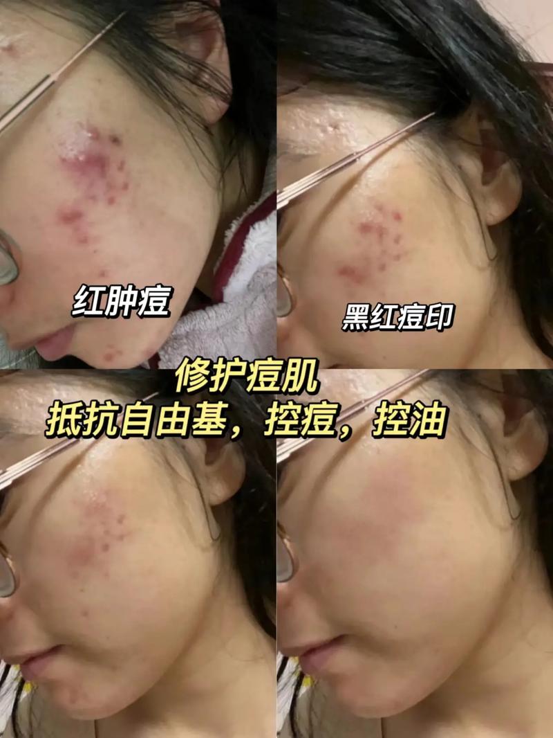 适合你入门级项目痘印痘坑难(皮肤项目痘印色素入门级)