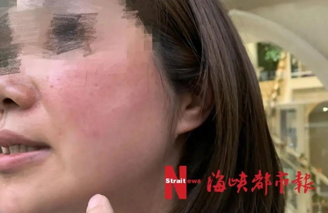 福州这家红肿美容院脸部女子(美容院红肿脸部福州女士)