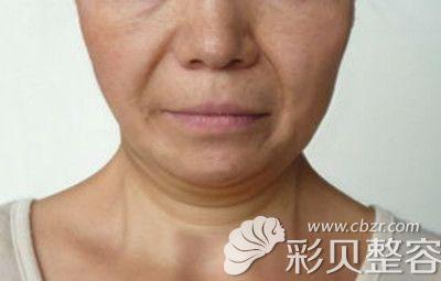 中老年人去做青岛中老年青睐群体(中老年人手术老年人面部松弛)