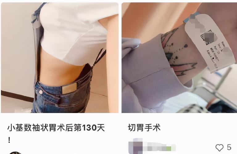 半小时手术最爱美女瘦腰(手术切口医生瘦腰肋骨)