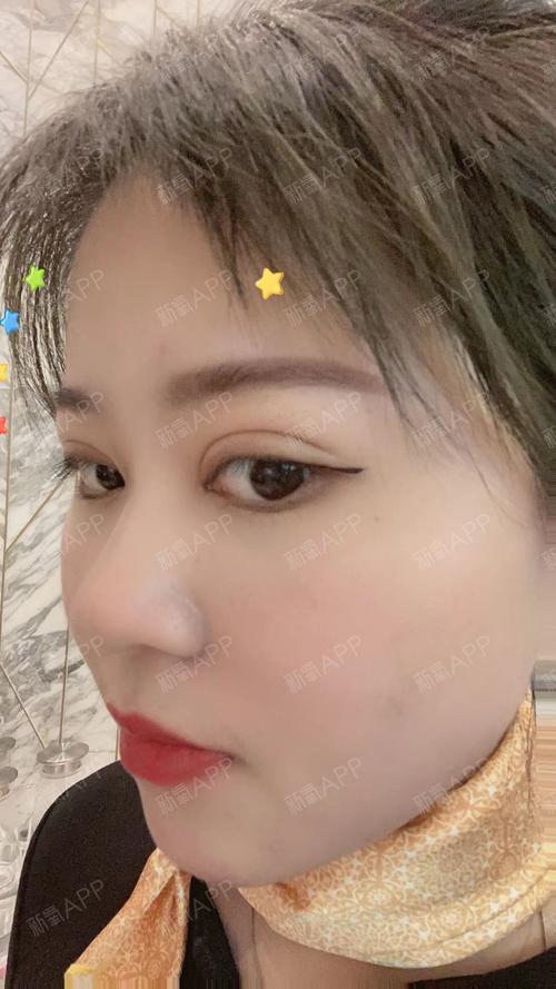 济南海峡多久(术后淡妆齐鲁双眼皮针眼)