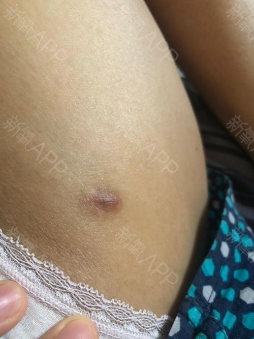 瘢痕醒目额头大腿抽脂腿都瘸(瘢痕大腿额头抽脂女士)