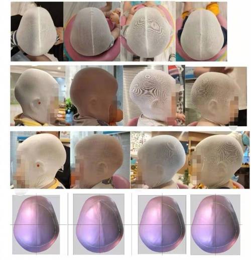 万元头型头盔婴儿想得美(头型头盔孩子焦虑自己的)