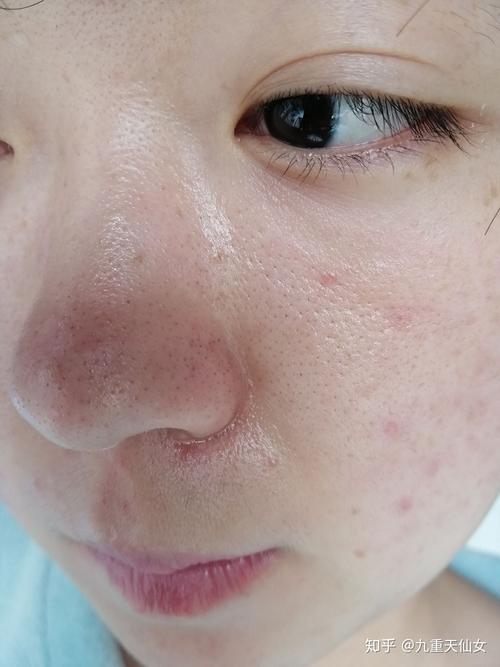 油光粗大毛孔满面(毛孔粗大皮肤皮脂腺日常)