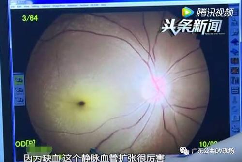 右眼眼角液体女子黄金(脂肪血管右眼面部动脉)