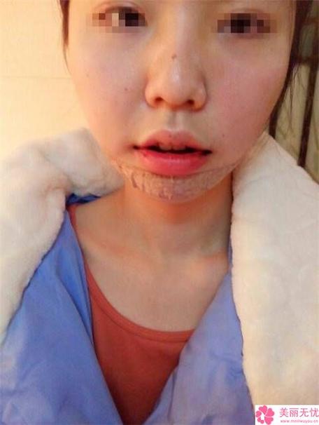 诊所下巴最新进展女子效果(诊所张女士下巴效果顾问)
