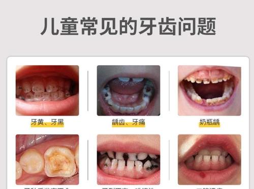 蛀牙牙齿有效预防宝宝社会看颜值(牙齿宝宝蛀牙乳牙孩子)