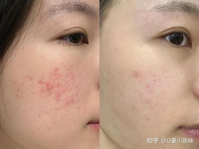 让你嫩肤雀斑十八岁克星激光(激光嫩肤痘印雀斑痘痘)