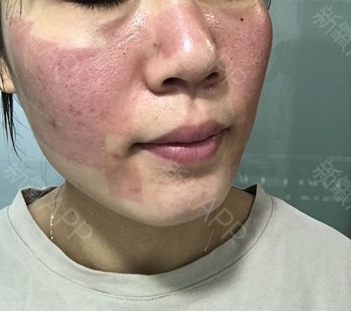 美白项目(美白项目皮肤科术后皮肤)