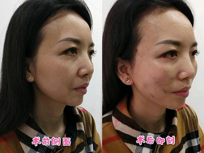 的人这是面部适合做整形手术(的人整形手术适合做这是面部)