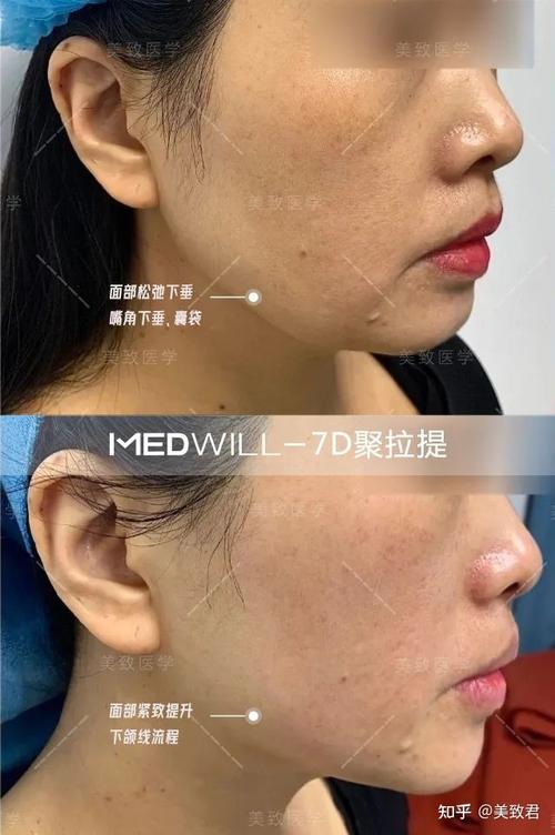 热议聚拉提(做完面部效果脸部建议)