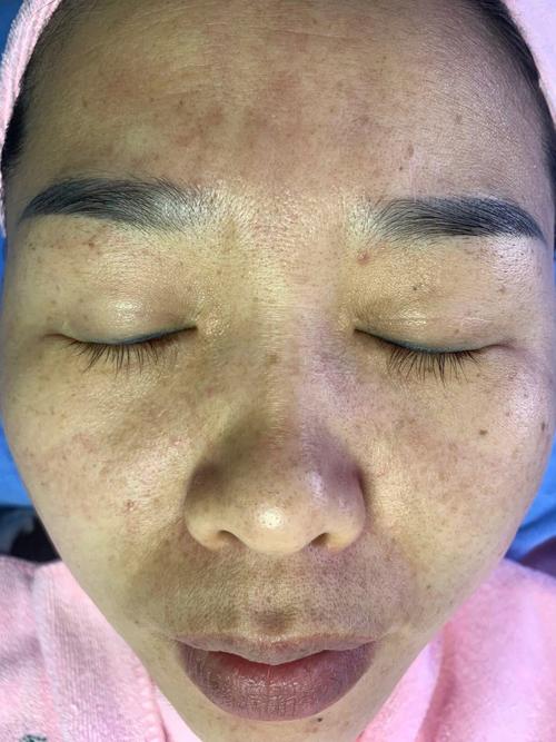 被判祛斑美容店典型案例专业(女士祛斑连云港市脸部专业)