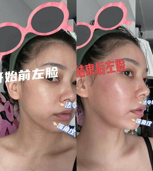 的是射频皱纹焦虑磨平(射频智商研究中心效果皮肤)