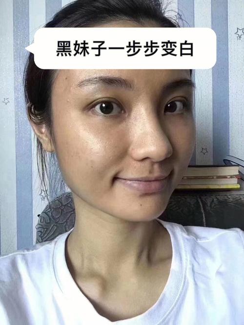 出油解决了痘印暗沉都(自生疗程胶原痘印出油)