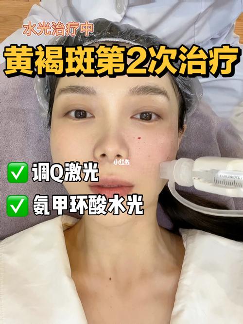 黄褐斑更要药物激光(黄褐斑更要药物激光自己的)