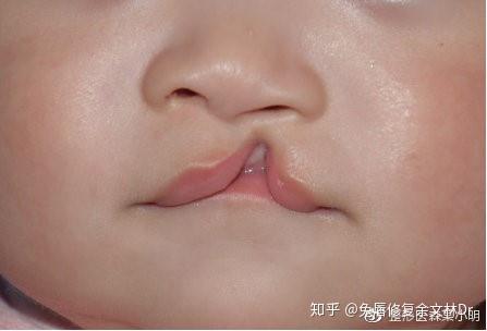 唇部都有哪些常见(唇部畸形常见都有哪些组织)