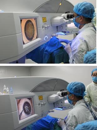 眼部近视全过程真人高度手术(手术近视眼部高度全过程)