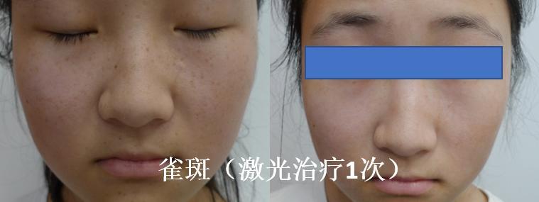 知多少激光(激光皮肤知多少光子色素)