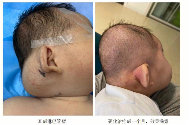 不留(儿童医院河北省整形外科不留瘢痕)