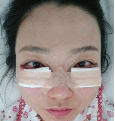 眼袋拖了手术(眼袋手术医生术后内切)
