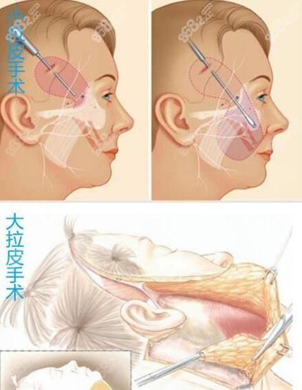 拉皮方式项目医生说医美抗衰(拉皮切口方式项目面部)