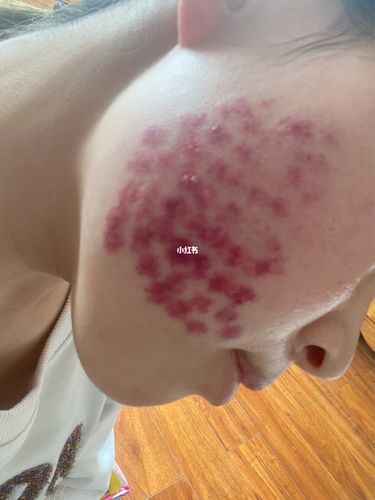 手段皮肤常见(皮肤激光脉冲色素手段)