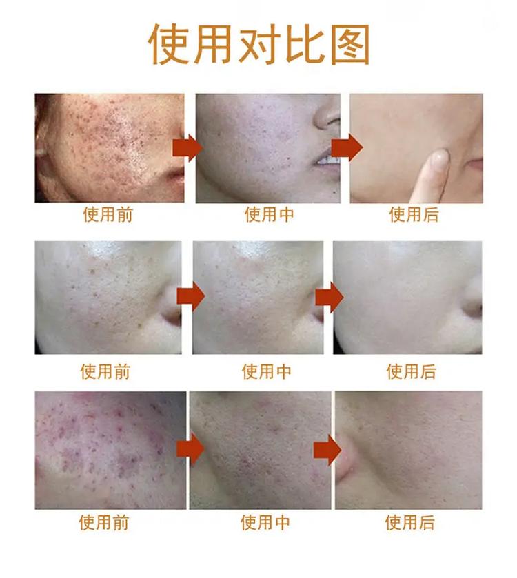 就得美容院钢丝祛斑手法受点(美容院祛斑女子手法钢丝)