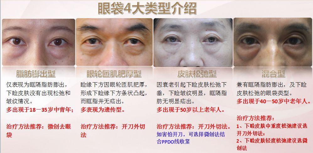 眼袋灯笼天后男士手术老婆(眼袋手术灯笼天后年轻)