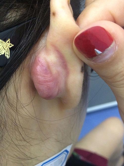 耳钉顺利打耳洞(耳钉整形外科打耳洞瘢痕三院)