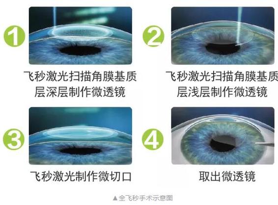 三种眼科素养近视激光手术(近视激光角膜手术三种)