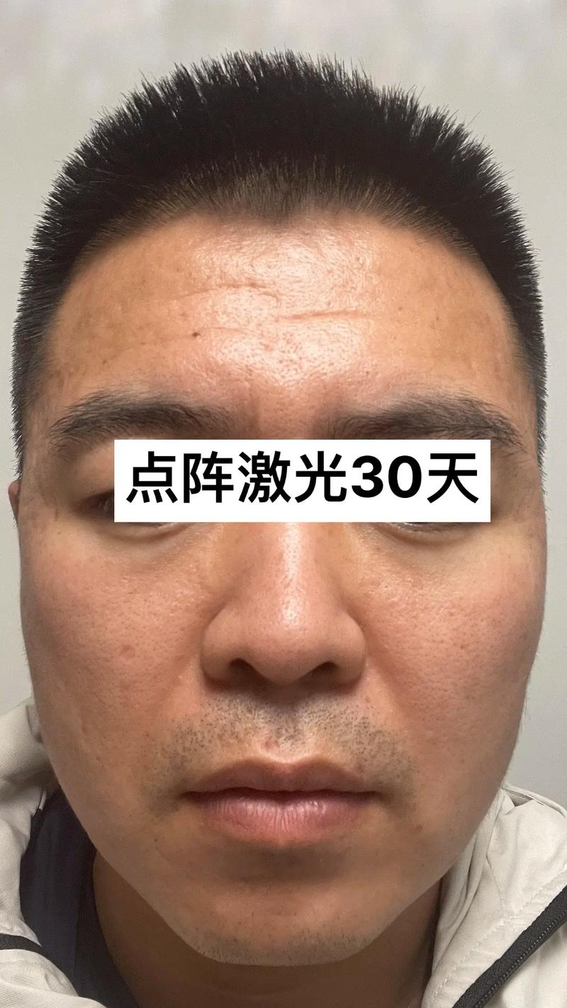 点阵事前激光历程祛痘(点阵医院痘痘激光医生)