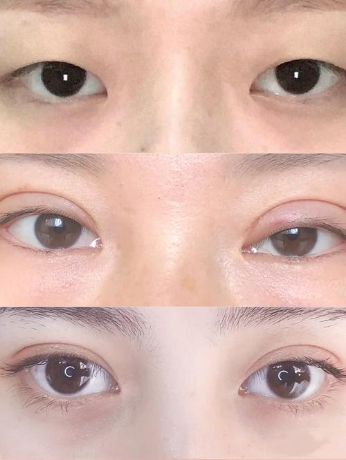 双眼皮博士(双眼皮博士眼睛自己的脂肪)
