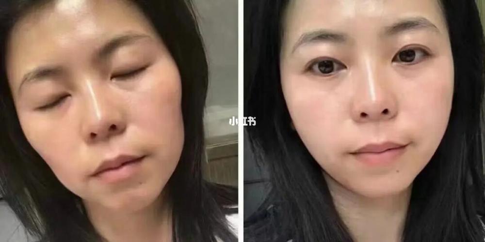 这件事都来姐妹建议项目抗老选医美(项目这件事都来皮肤姐妹)