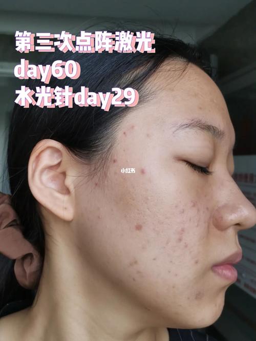 水光见效疫苗绝痘美肌不挤痘不针清(皮肤炎症水光疫苗痘痘)